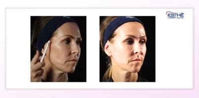 Služba – Profhilo Structura 2321