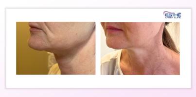 Linie čelisti, kontury obličeje, marionetové a nosoretní vrásky