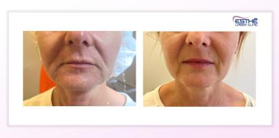 Služba – Morpheus8  2313