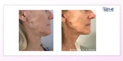 Morpheus8 – služba 2212