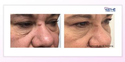 Morpheus8 – služba 2213