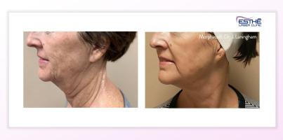 Kontury obličeje, čelistní linie, nosoretní a marionetové vrásky