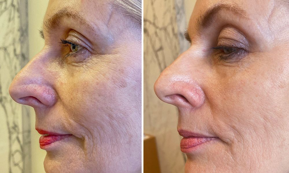 Úsměv ve článku Slavné trio: mezoterapie – botulotoxin – kožní výplně – Esthé Laser Clinic