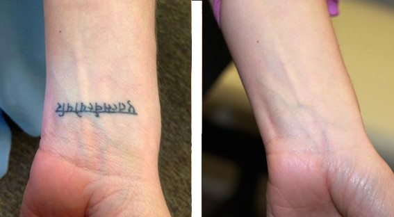 Odstranění tetování